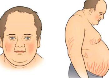 Cushing Sendromu Nedir? Belirtileri Nelerdir?