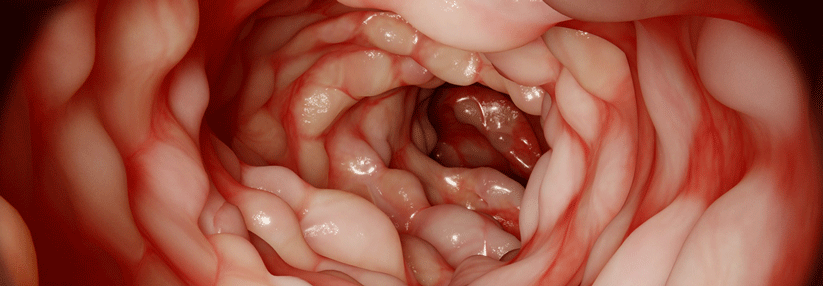 Crohn Hastalığı Nedir? Belirtileri ve Tedavisi