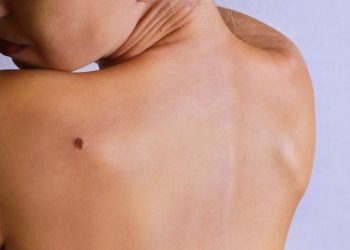 Cilt Kanseri Türleri, Belirtileri ve Tedavisi