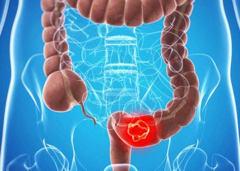 Kolon (Bağırsak) Kanseri Nedir ? Tedavisi Nasıl Olur ?