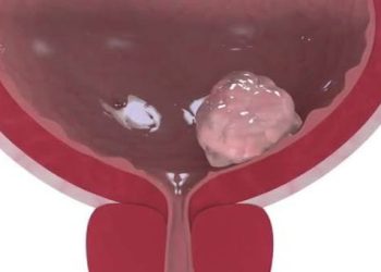 Mesane Kanseri Belirtileri ve Tedavisi