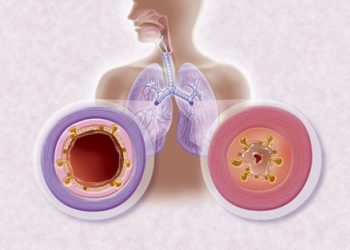 Bronşit Hastalığı Nedir? Belirtileri Nelerdir?