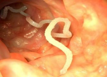 Kıl Kurdu (Bağırsak Kurdu) Nedir ve Neden Olur?