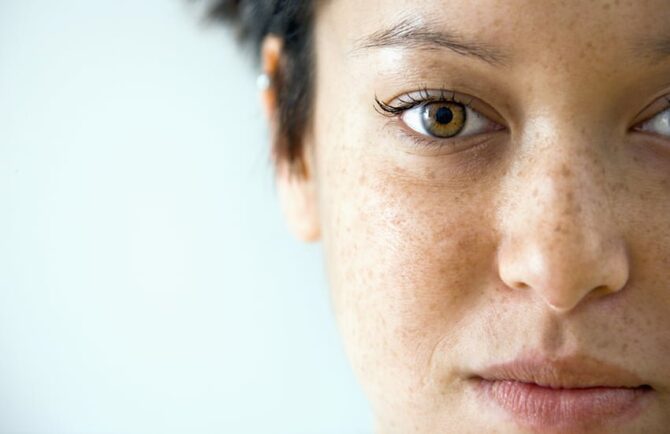 Cilt Benleri (Melanom) Tehlikeli Midir ?